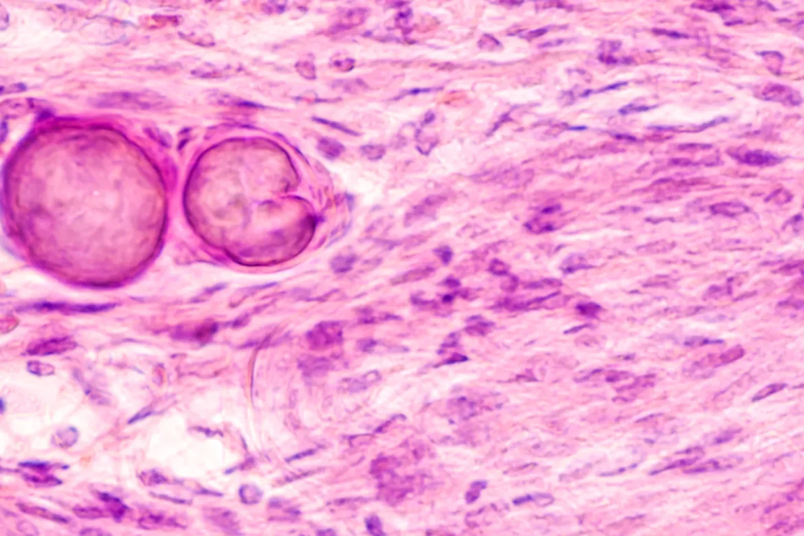 Często spotykane pierwotne guzy mózgu to oponiaki (łac. meningioma).